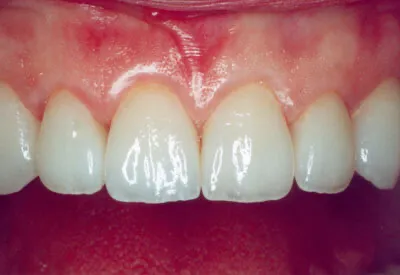 Porcelain Veneers - After
