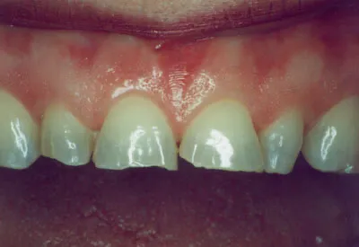 Porcelain Veneers - Before
