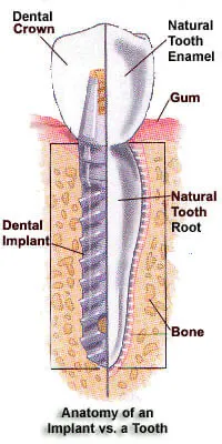 dentalimplant.webp