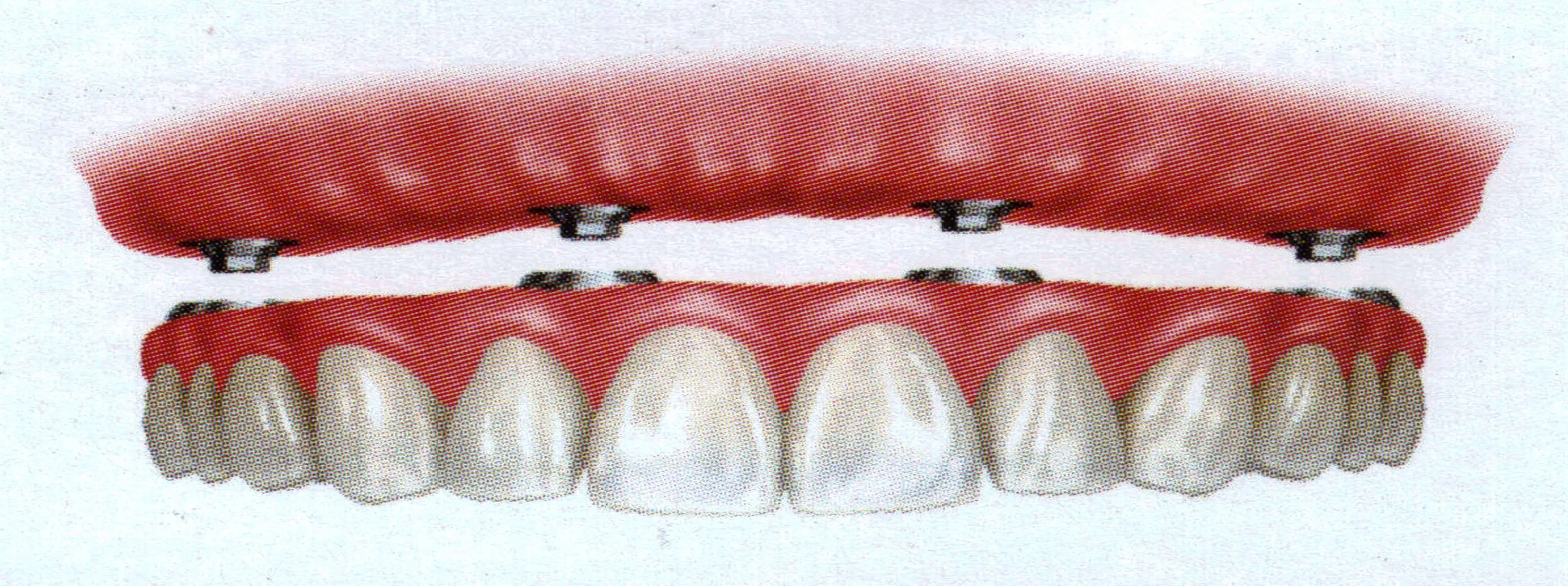 denture_2